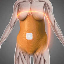 Load image into Gallery viewer, NANO TRIM™ MICRONEEDLE SLIM PATCHES (X2 BOX – 8 PCS)
